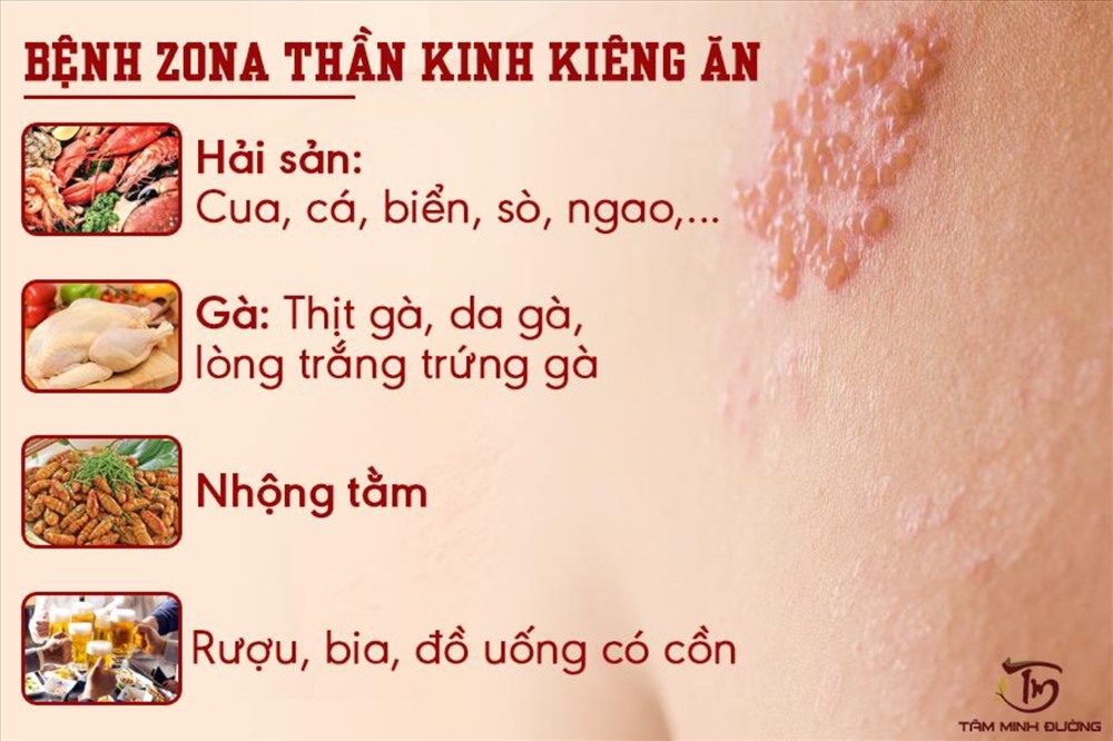 Một số loại thực phẩm người bị zona thần kinh cần tránh xa