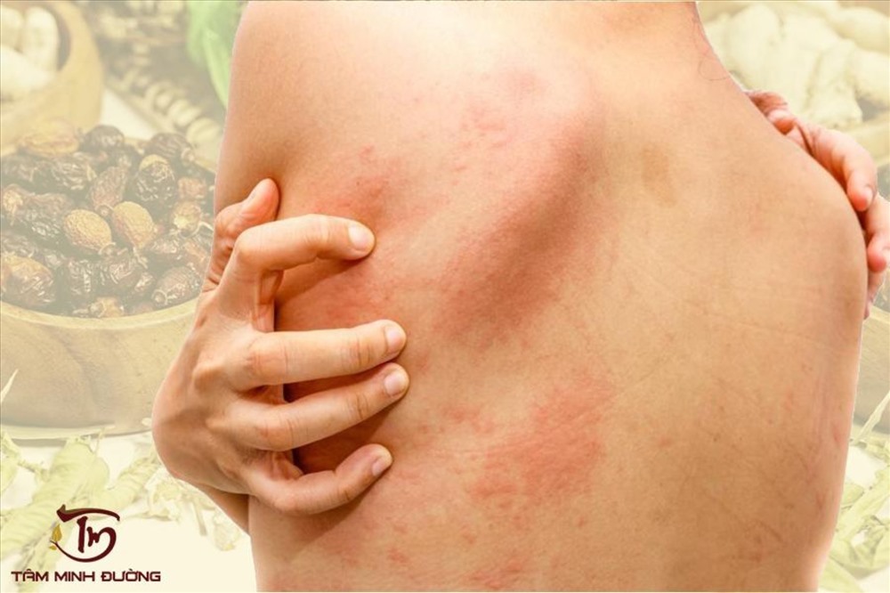 Hình ảnh bệnh nhân bị nổi mề đay