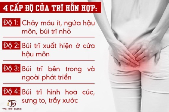 Các cấp độ trĩ hỗn hợp và đặc điểm