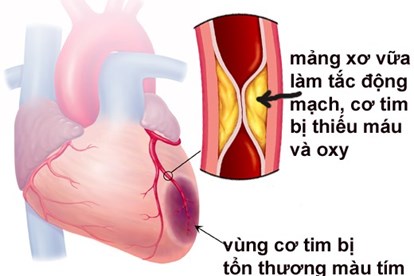 Căn bệnh nhồi máu cơ tim NSND Thế Anh mắc nguy hiểm thế nào? | Tin tức mới nhất 24h - Đọc Báo Lao Động online - Laodong.vn