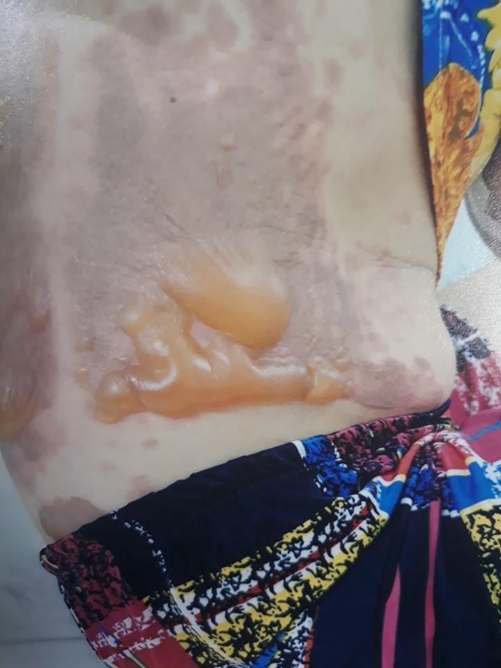 Nạn nhân Ly bị bỏng cấp độ II. Ảnh: Cao Huân.