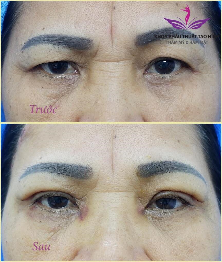 Mt n bnh nhn trung tui rt h¨¤i l¨°ng sau khi c ct m¨ª. nh: BSCC