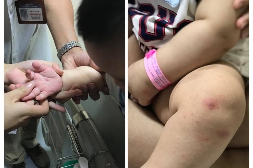 Nốt phỏng nước xuất hiện nhiều ở tay, chân, miệng của bệnh nhi. Ảnh: Thùy Linh