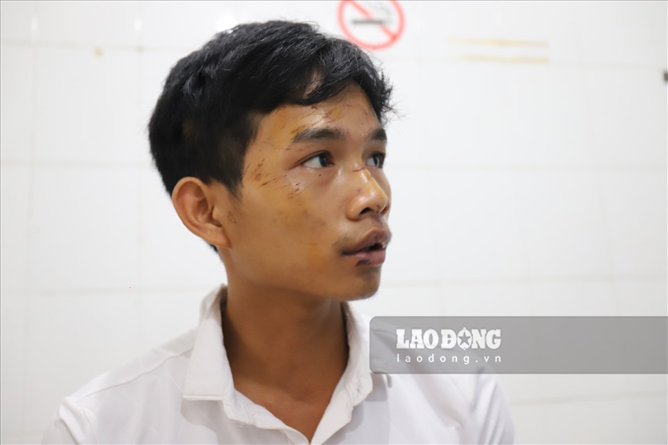 Ho Van Thoan's face with many scratches.  Photo: Huu Long