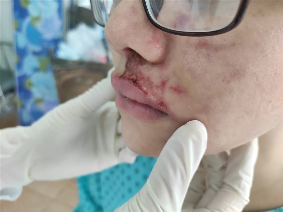 Một cô gái 26 tuổi sưng phù mặt, mưng mủ do tiêm filler làm đầy má ở thẩm mỹ viện. Ảnh: Bệnh viện Da liễu TPHCM Một cô gái 26 tuổi sưng phù mặt, mưng mủ do tiêm filler làm đầy má ở thẩm mỹ viện. Ảnh: Bệnh viện Da liễu TPHCM