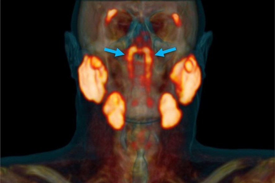 Cặp tuyến nước bọt thứ tư được các bác sĩ Hà Lan phát hiện nằm ở nơi khoang mũi nối với cổ họng. Ảnh: NY Post