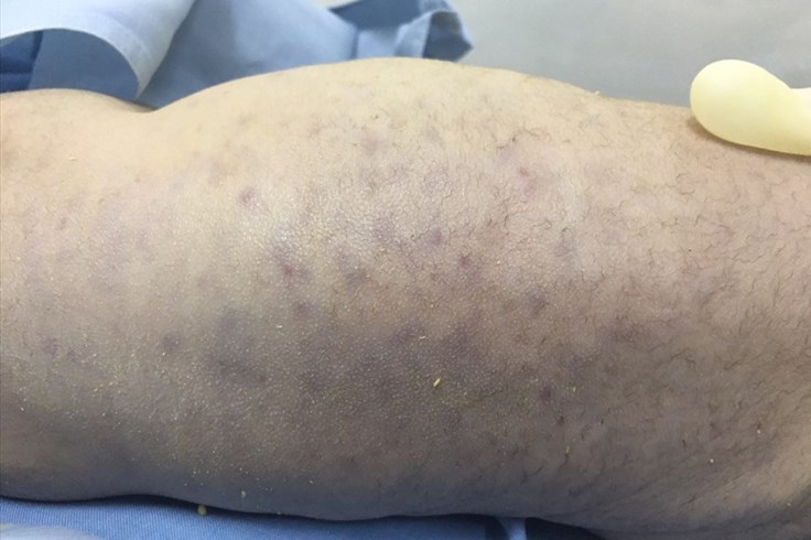 Trẻ sơ sinh nguy kịch nghi do nhiễm virus gây bệnh nhiễm trùng Trẻ sơ sinh nguy kịch nghi do nhiễm virus gây bệnh nhiễm trùng