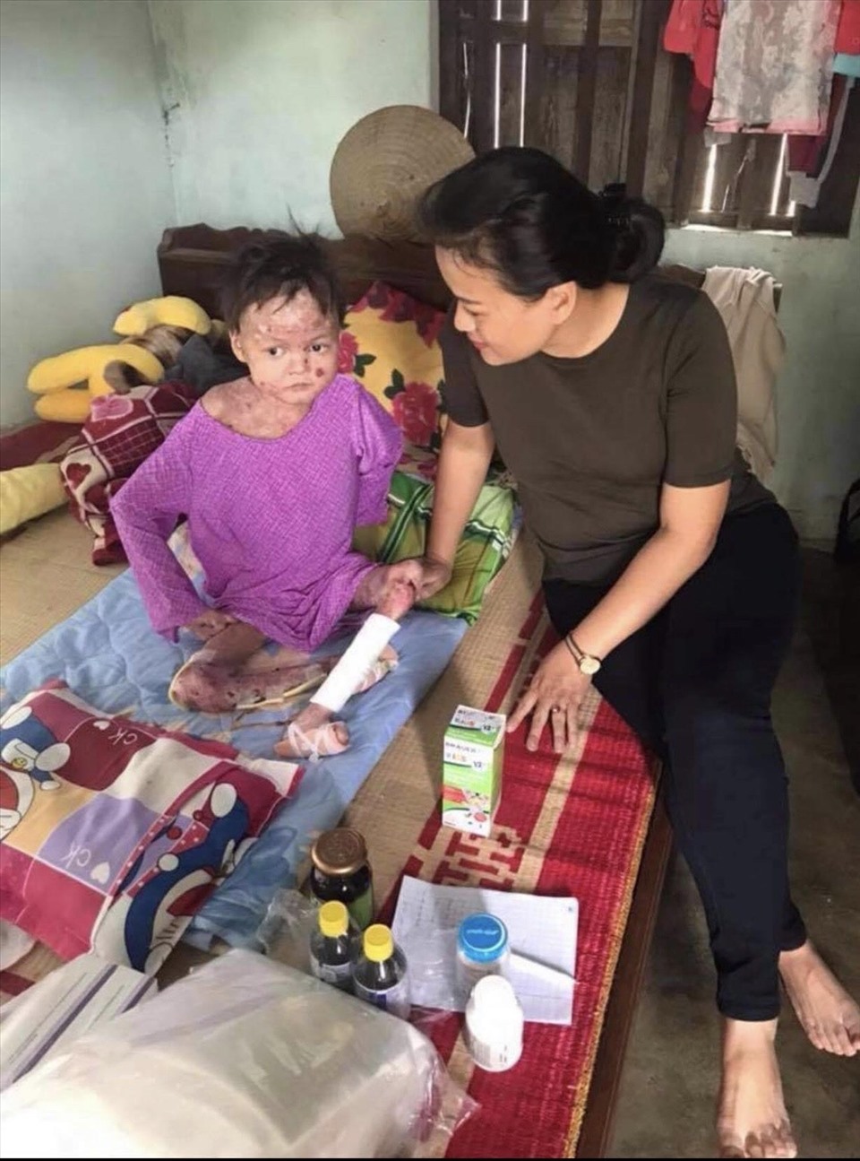 Công việc bận rộn, nhưng chị luôn giành thời gian thăm nom các bé bị bệnh ly thượng bì bọng nước. Ảnh: NVCC