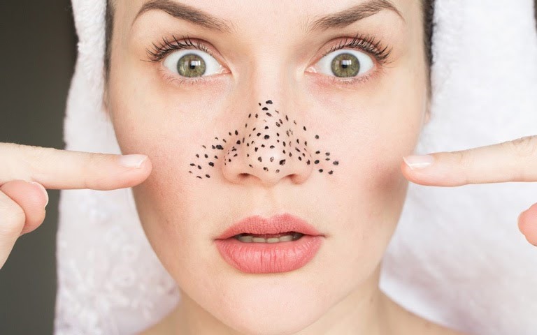 Mụn đầu đen không gây ảnh hưởng tới sức khoẻ nhưng gây mất thẩm mỹ. Ảnh: 2health.