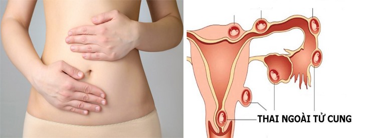 Có thai ngoài tử cung gây ảnh hưởng tới sức khỏe sinh sản và tính mạng của thai phụ. Đồ họa: Hồng Nhật