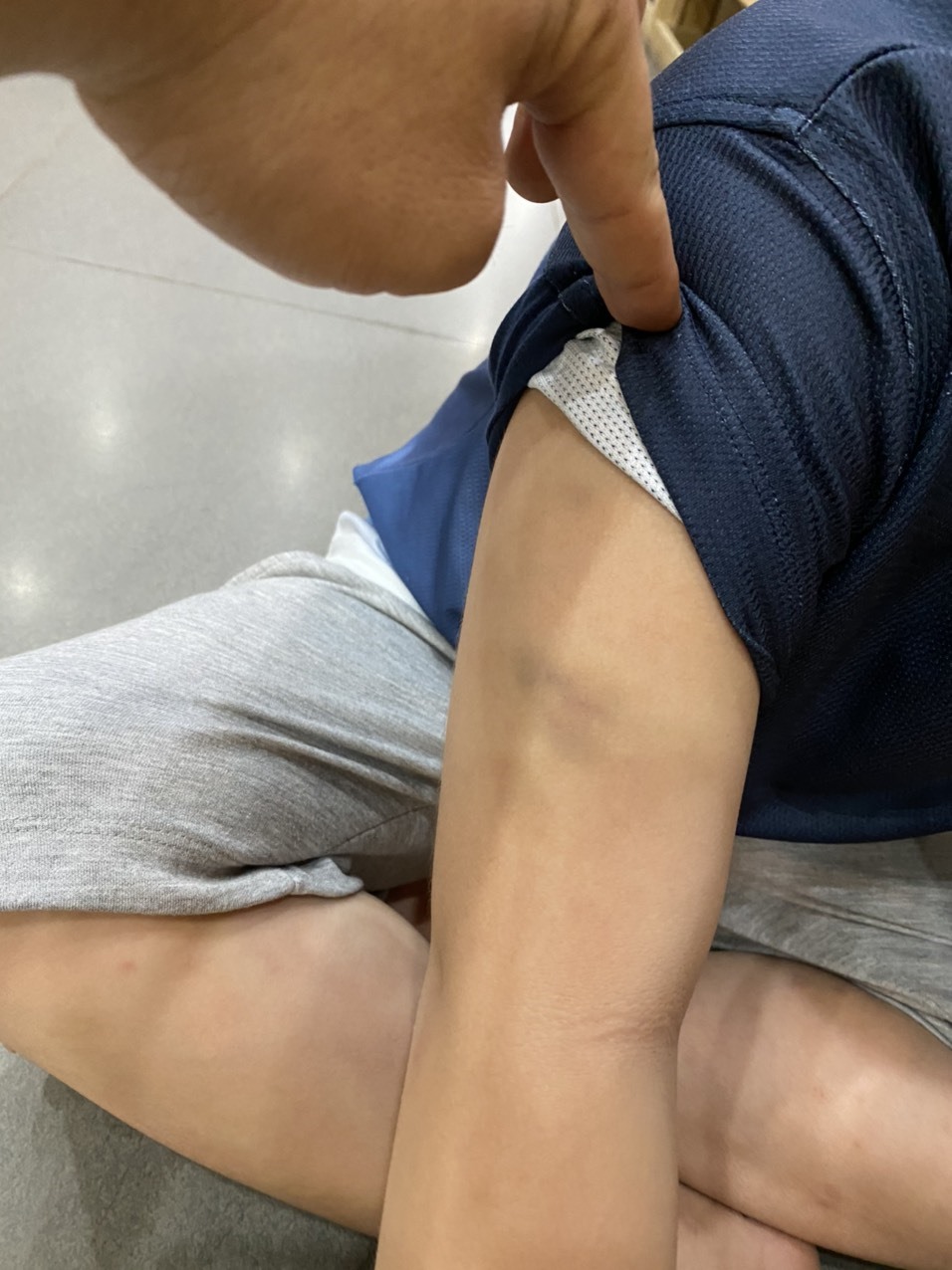 Một vết bầm tím khác ở cánh tay. Ảnh: Gia đình cung cấp.