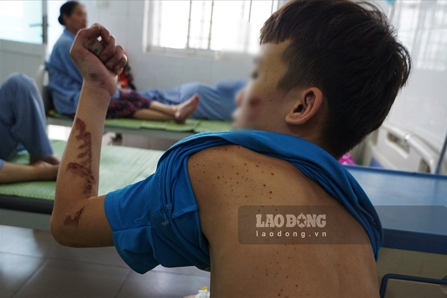 Trên lưng, mặt, tay, chân... đều là những vết thương do bị chủ quán bánh xèo ở Bắc Ninh tra tấn hơn 1 tháng nay. Ảnh: Tùng Giang.