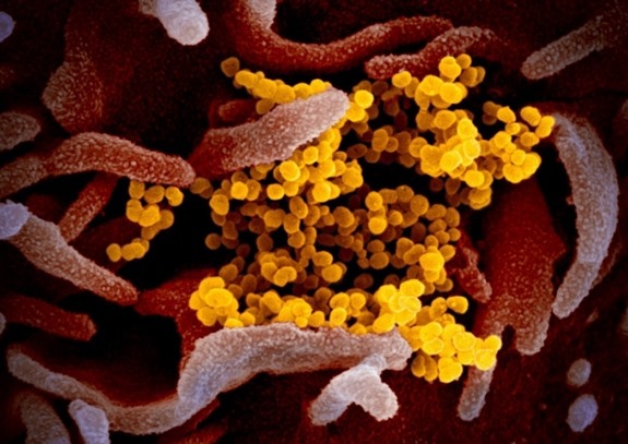 Từ một virus ban đầu, virus SARS-CoV-2 nhân lên thành nhiều hạt virus mới (màu vàng) gây tổn thương tế bào chủ.