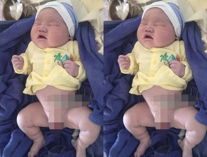 Ngày 25.2.2016 chị Nguyễn Thị T (32 tuổi, Trực Ninh, Nam Định) đã hạ sinh bé trai nặng 6,1kg bằng phương pháp sinh mổ tại Bệnh viện Đa khoa Công an tỉnh Nam Định. Lúc mang thai, bác sĩ chẩn đoán em bé có cân nặng khoảng 4,5kg, nhưng khi sinh bé có cân nặng đến 6,1kg.