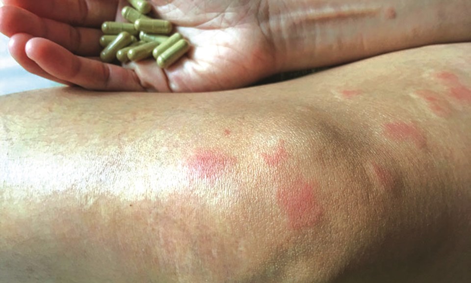 Bệnh nhân bị bệnh Lupus ban đỏ. Ảnh: Bệnh viện Đại học Y dược TPHCM Bệnh nhân bị bệnh Lupus ban đỏ. Ảnh: Bệnh viện Đại học Y dược TPHCM