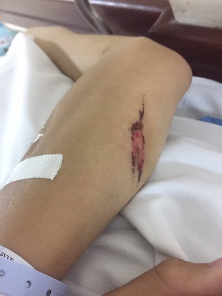 Một vết thương khác ở tay K do gậy gỗ gây ra. Ảnh: GĐCC