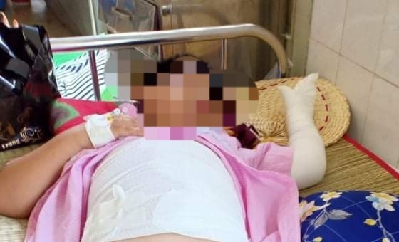 Cháu bé 9 tuổi cũng bị bỏng nặng. Ảnh: Người dân cung cấp