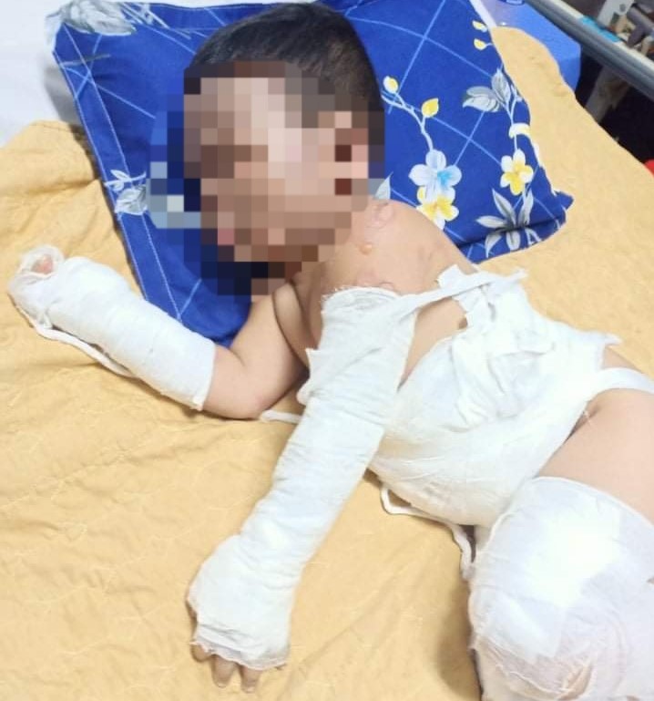 Em bé bị bỏng nặng khắp người. Ảnh: Đình Trọng