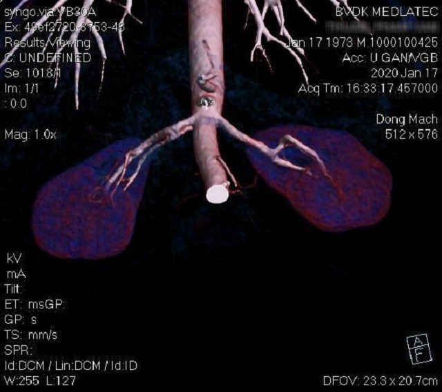 Ca chụp CT Gan tại Bệnh viện Đa khoa MEDLATEC. Ảnh: MEDLATEC