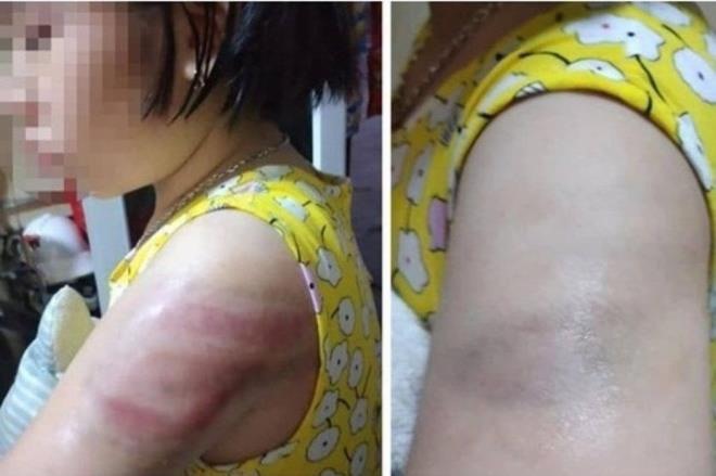 Học sinh ở Nam Định bị cô giáo đánh bầm tay vì làm bài tập chậm, thiếu tập trung. Ảnh: PHCC