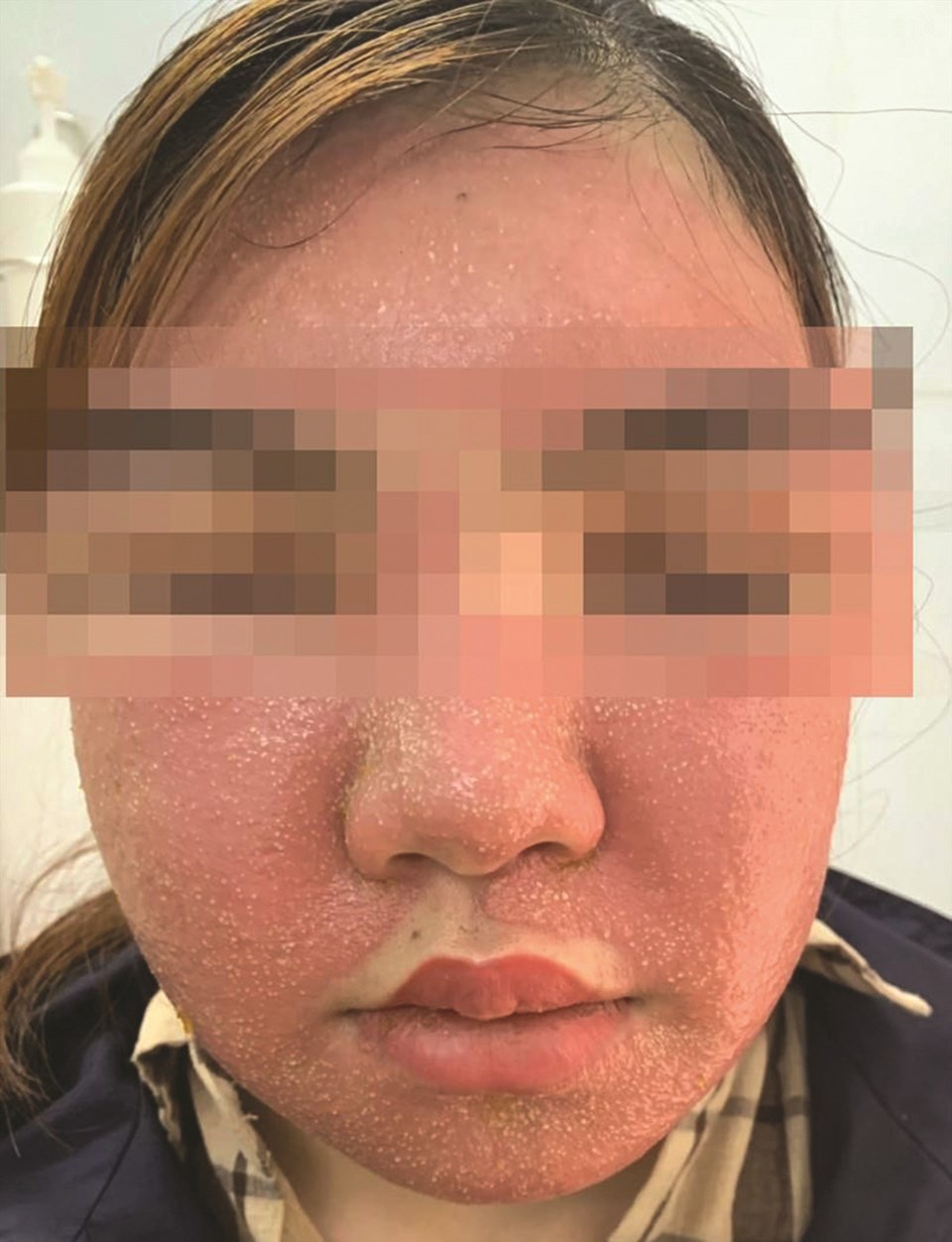 Khuôn mặt bệnh nhân bị ban đỏ, sưng phù sau khi đắp mặt nạ đông y. Ảnh: Bệnh viện cung cấp Khuôn mặt bệnh nhân bị ban đỏ, sưng phù sau khi đắp mặt nạ đông y. Ảnh: Bệnh viện cung cấp