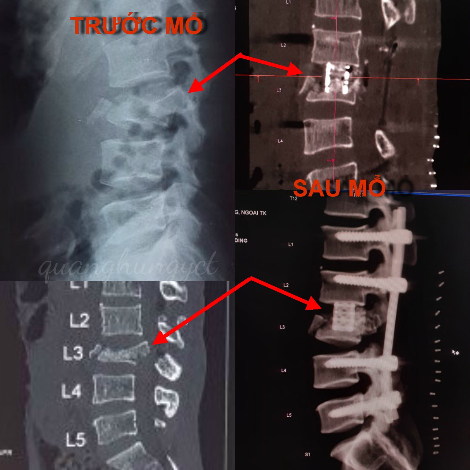 Hình ảnh sau khi phẩu thuật. Ảnh: B.V cung cấp