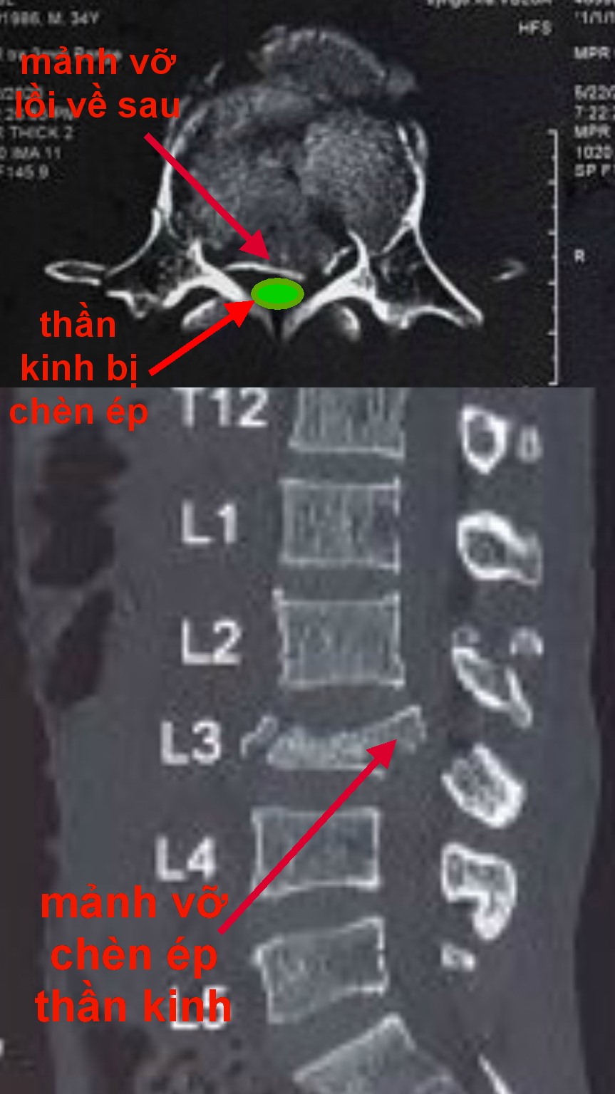 Hình ảnh tổn thương đốt sống. Ảnh: B.V cung cấp