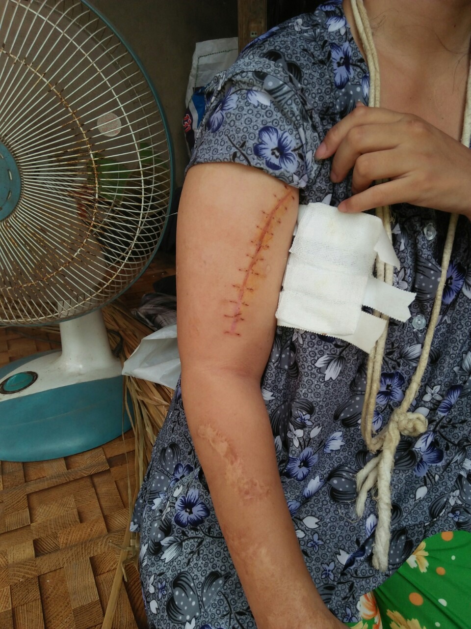 Kim Hưng bị tai nạn gãy tay. Ảnh: K.Q