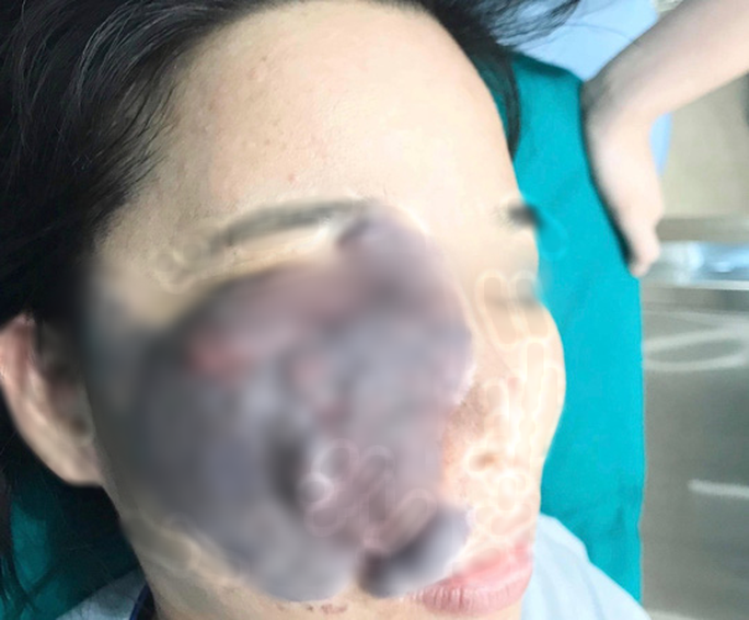 U máu trên khuôn mặt bệnh nhân trước khi phẫu thuật. Ảnh do bác sĩ cung cấp.