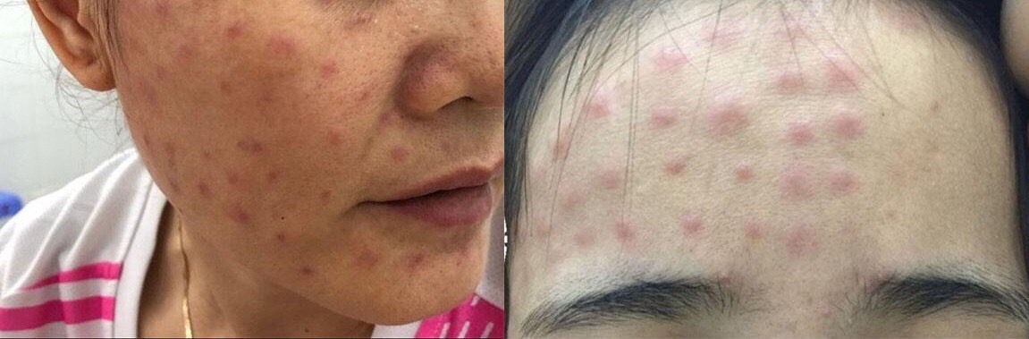 Da mặt bệnh nhân nổi những nốt đỏ, sần do tiêm tế bào gốc. Ảnh: Bệnh viện Da liễu TPHCM