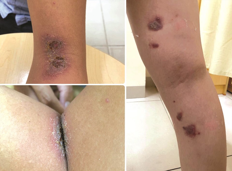 Viêm da do kiến ba khoang gây ra. Ảnh: Bệnh viện Đại học Y Dược cung cấp Viêm da do kiến ba khoang gây ra. Ảnh: Bệnh viện Đại học Y Dược cung cấp