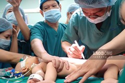 Đển 14h10 hai bé song sinh dính nhau đã được tách rời thành công
