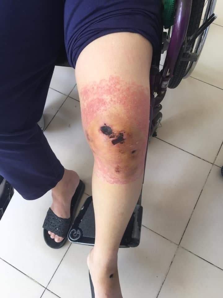 Sau 1 tuần đắp lá vết thương của bệnh nhân Đ. không giảm mà còn sưng tấy, có dịch và rộp vùng da xung quanh. Ảnh: Phương Linh