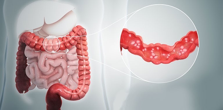 Dùng kháng sinh có thể vô tình giết nhầm lợi khuẩn