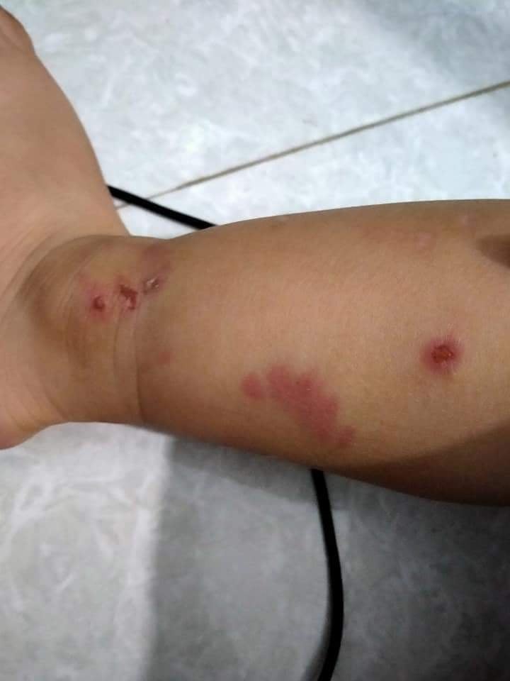 Hình ảnh gia đình đăng tải lên mạng xã hội về vết thương cháu P. do bạn cắn.