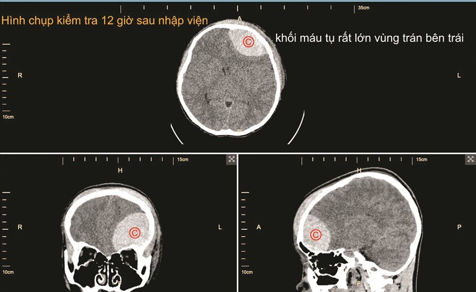 Hình chụp kiểm tra sau 12 giờ nam sinh bị tai nạn giao thông nhập viện. Ảnh: Bệnh viện Nhi đồng 2 TPHCM. Hình chụp kiểm tra sau 12 giờ nam sinh bị tai nạn giao thông nhập viện. Ảnh: Bệnh viện Nhi đồng 2 TPHCM.