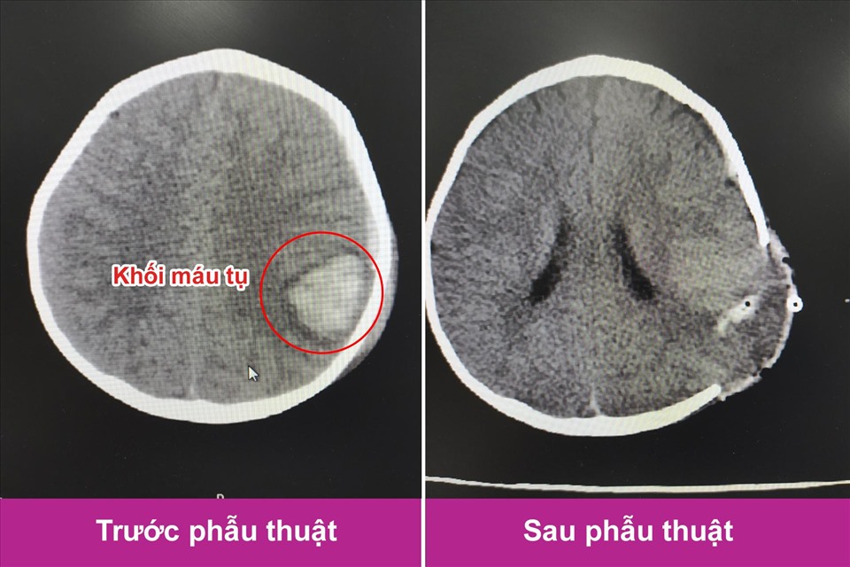 Hình ảnh trước và sau phẫu thuật lấy máu tụ nội sọ cho bệnh nhi. Ảnh: Hà Nguyệt.