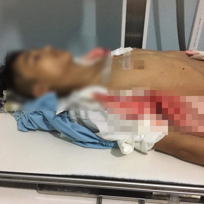 Học sinh lớp 11 ở Hà Giang bị bạn đâm thấu ngực tại cổng trường, đang được điều trị tại bệnh viện. Ảnh: P. Họ