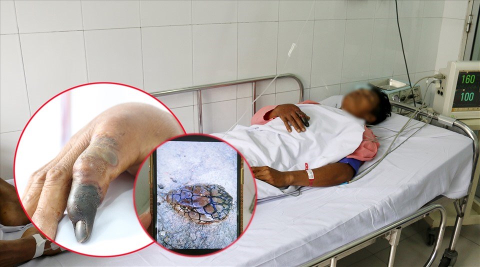 Người đàn ông phải tháo khớp vì bị rắn hổ mang cắn. Ảnh: Bệnh viện Chợ Rẫy cung cấp Người đàn ông phải tháo khớp vì bị rắn hổ mang cắn. Ảnh: Bệnh viện Chợ Rẫy cung cấp