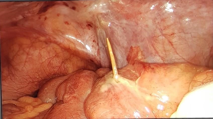 Chiếc tăm nằm trong ruột người bệnh. Ảnh do bệnh viện cung cấp.