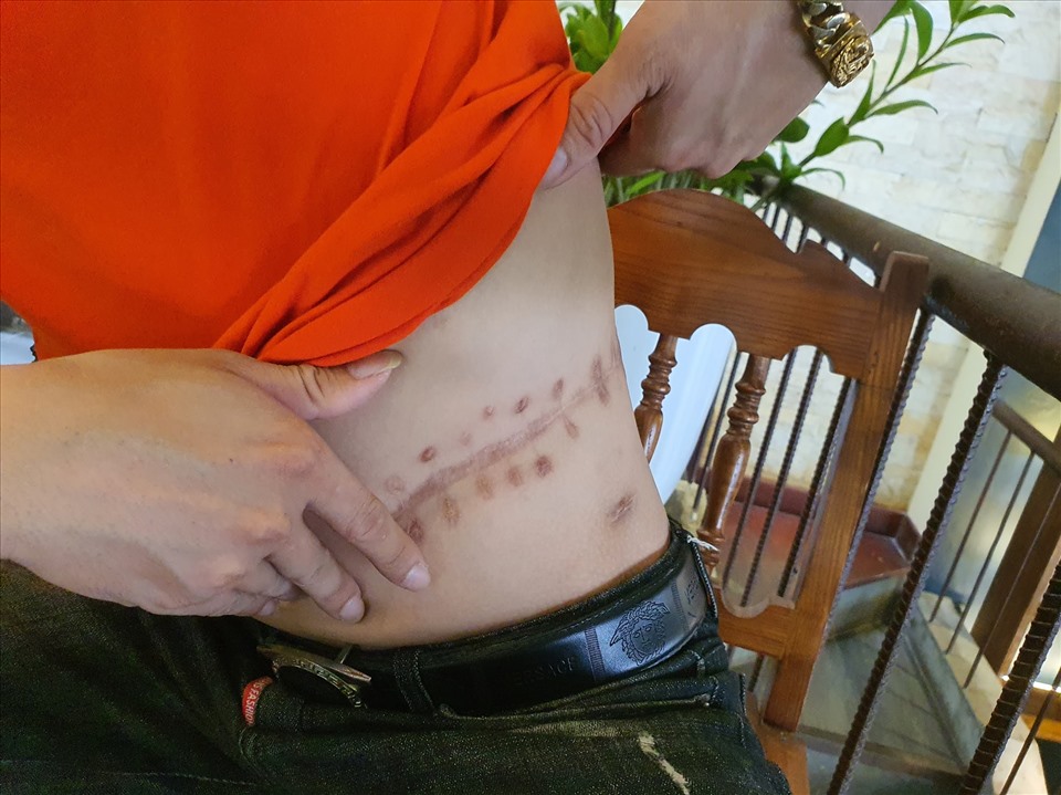 Ca mổ bán thận khiến sức khoẻ của Tú suy giảm nghiêm trọng. Ảnh: Phương Linh.