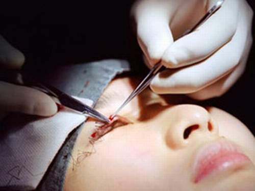 Một ca cắt mí nếu đúng thao tác diễn ra rất nhanh và an toàn