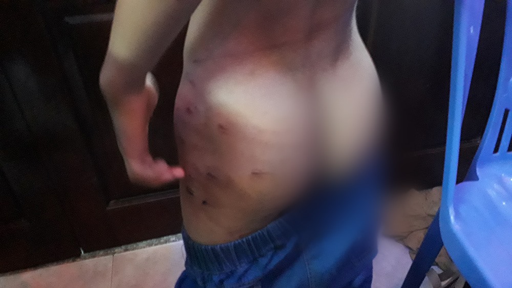 Những vết bầm tím trên người cháu N. Ảnh: PĐ.