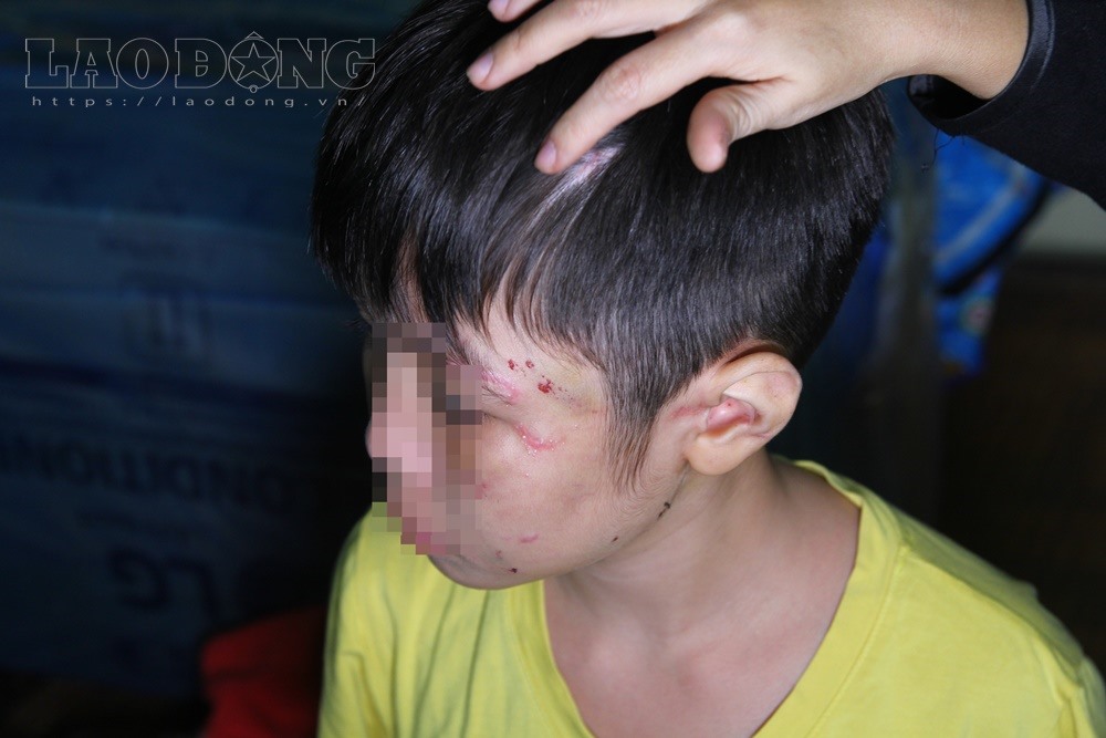 Những vết thương chi chít trên mặt cháu bé.