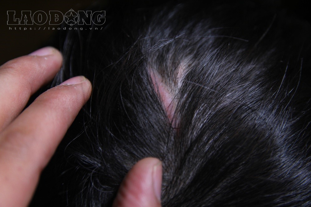 Và nhiều vết sẹo lớn trên đầu.