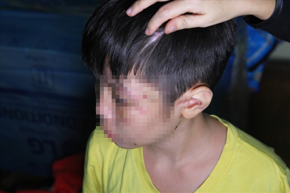 Cháu bé bị bạo hành.