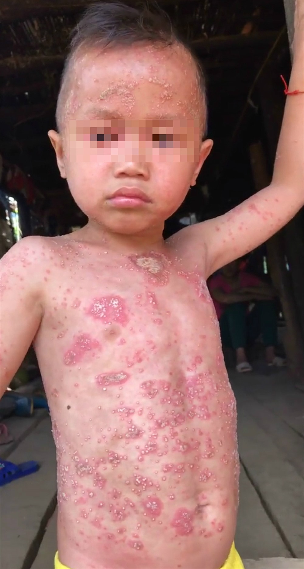 Cháu bé bị mệnh danh là người cóc, mọi người xung quanh không dám gần. Ảnh: PV