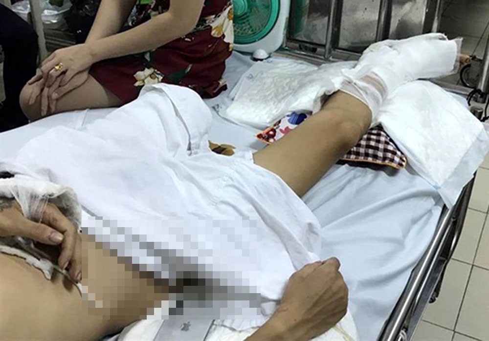 Anh Hùng phải cắt bỏ một phần chân trái.