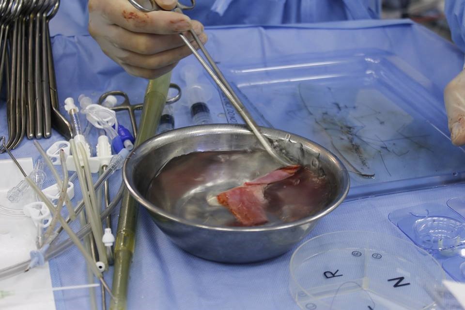 Kỹ thuật mổ sử dụng vật liệu tự thân làm van tim, tiết kiệm 40 triệu đồng cho người bệnh - ảnh 3 Kỹ thuật mổ sử dụng vật liệu tự thân làm van tim, tiết kiệm 40 triệu đồng cho người bệnh - ảnh 3