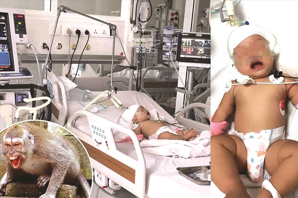Bé gái bị khỉ tấn công: ảnh BV Nhi Đồng TPHCM.